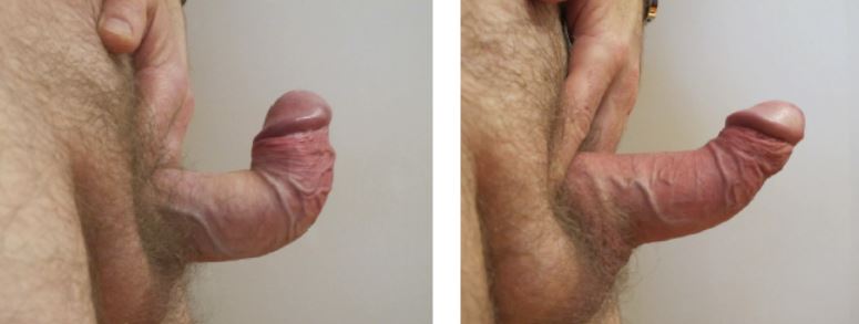 Before-and-after photo PeniMaster PRO Peyronie